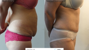 be_af_mdg_tummytuck3