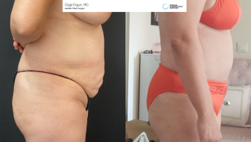 be_af_tummytuck_2_65542874