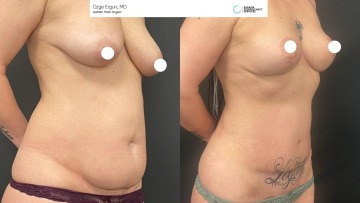 be_af_tummytuck_2__67932006